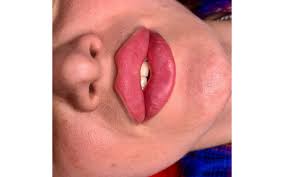 Фото: Увеличение губы