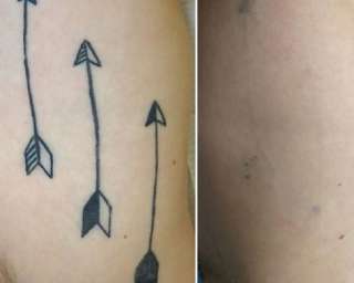 Фото: Удаление татуировок лазером пиковей