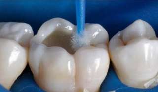 Объявление с Фото - Восстановление стершихся зубов