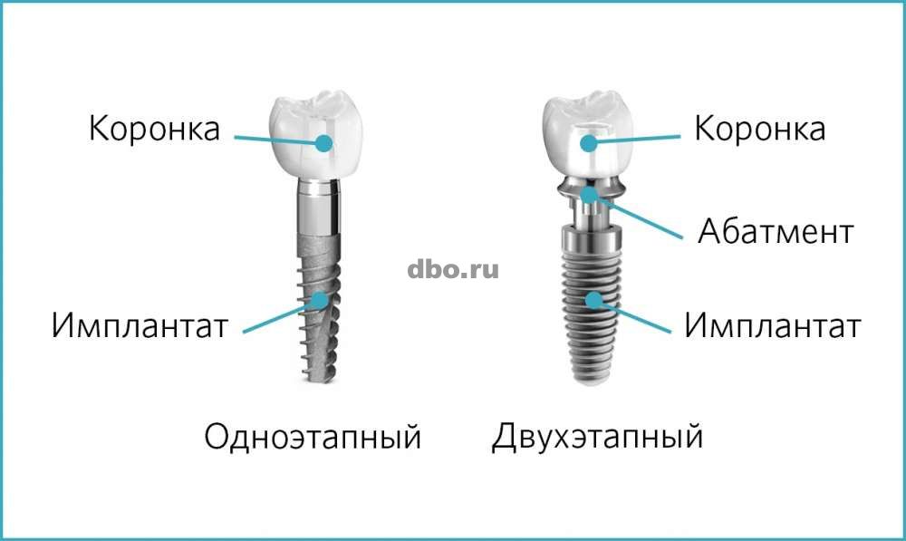 Фото: Имплантация зубов