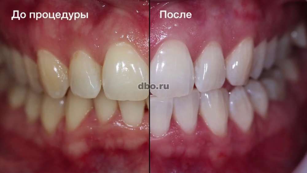 Фото: Отбеливание зубов